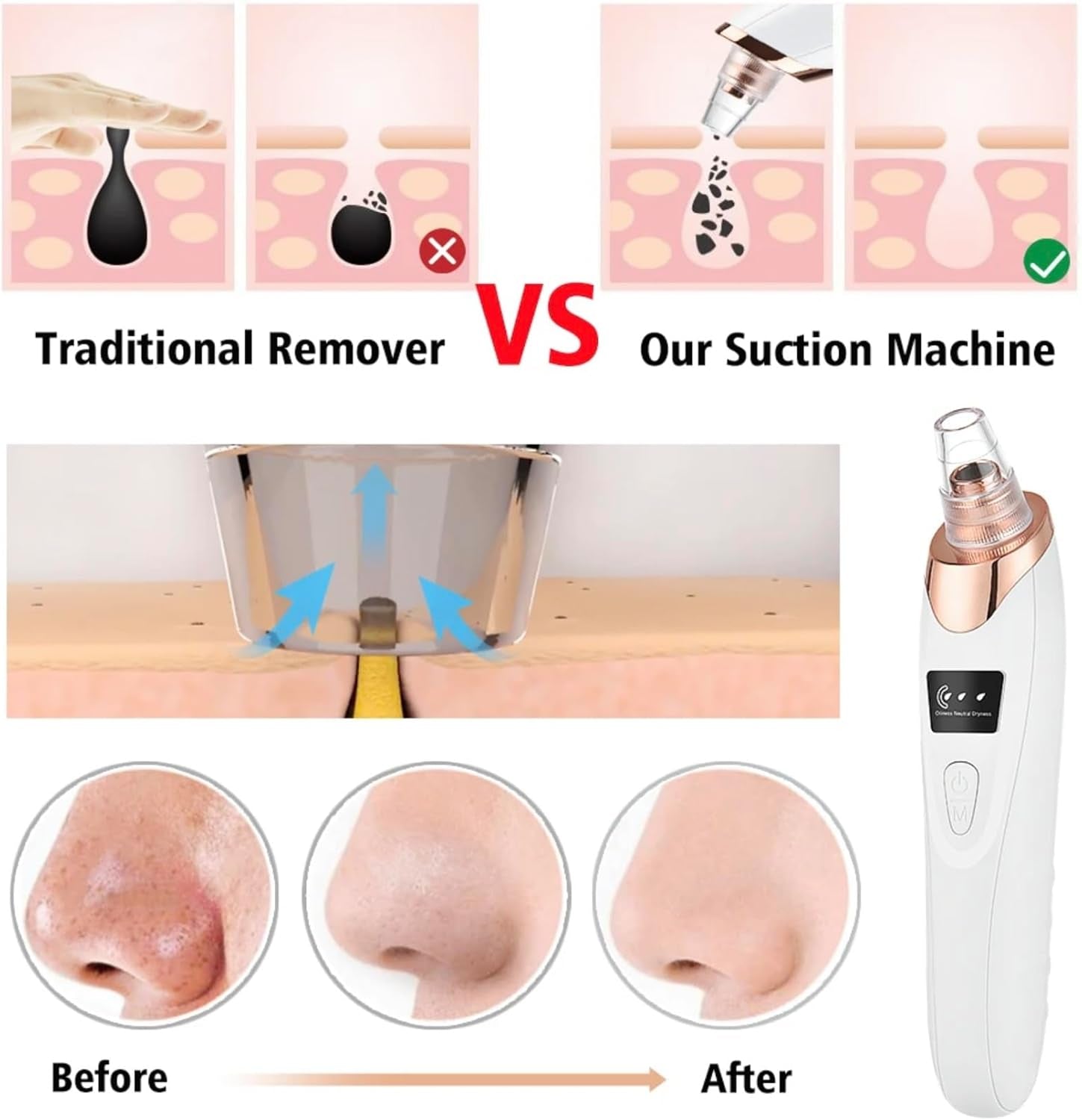 Blackhead Remover Vacuum
